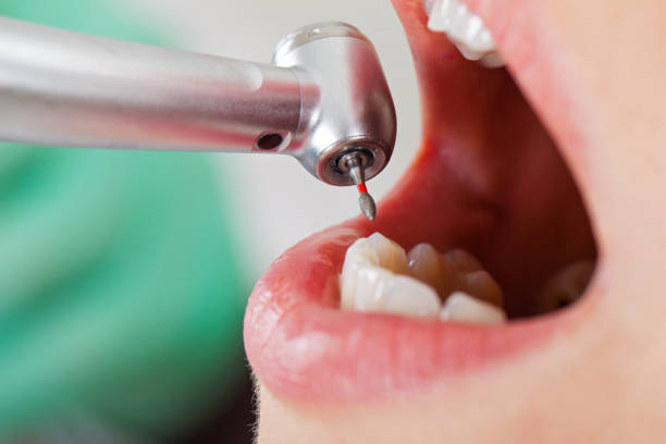 Best Emergency Root Canal Treatment in Belington, WV